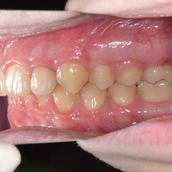 Kezelés után - jobb oldalról