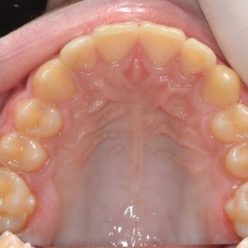 Kezelés után - felső rágófelszín