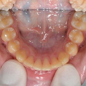 Kezelés után - alsó rágófelszín