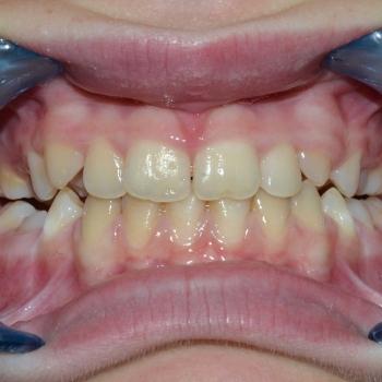 Kezelés előtt - szemből