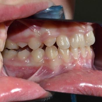 Kezelés előtt - bal oldalról