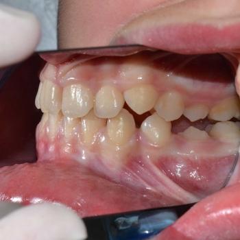 Kezelés előtt - jobb oldalról