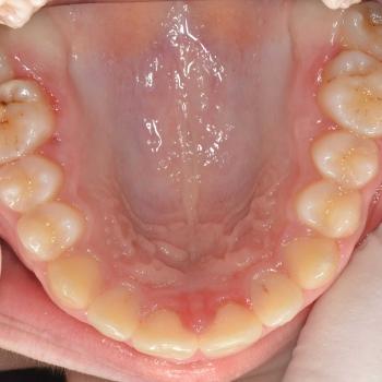 Kezelés után - felső rágófelszín